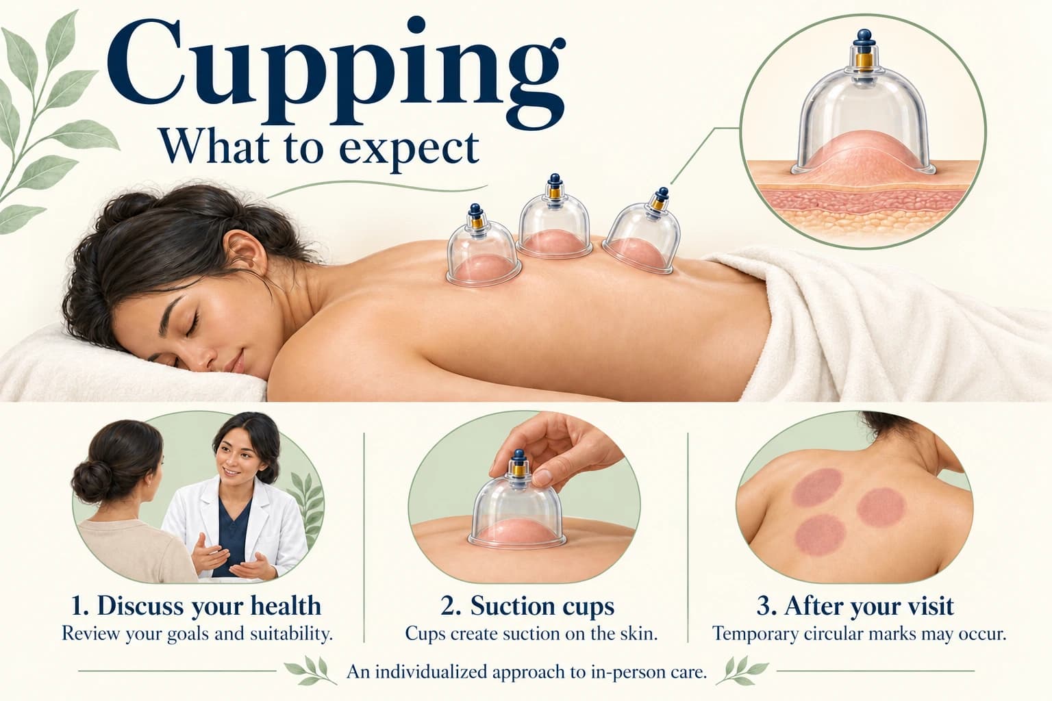 Cupping illustrated guide: consultation, suction cups, and temporary circular marks.